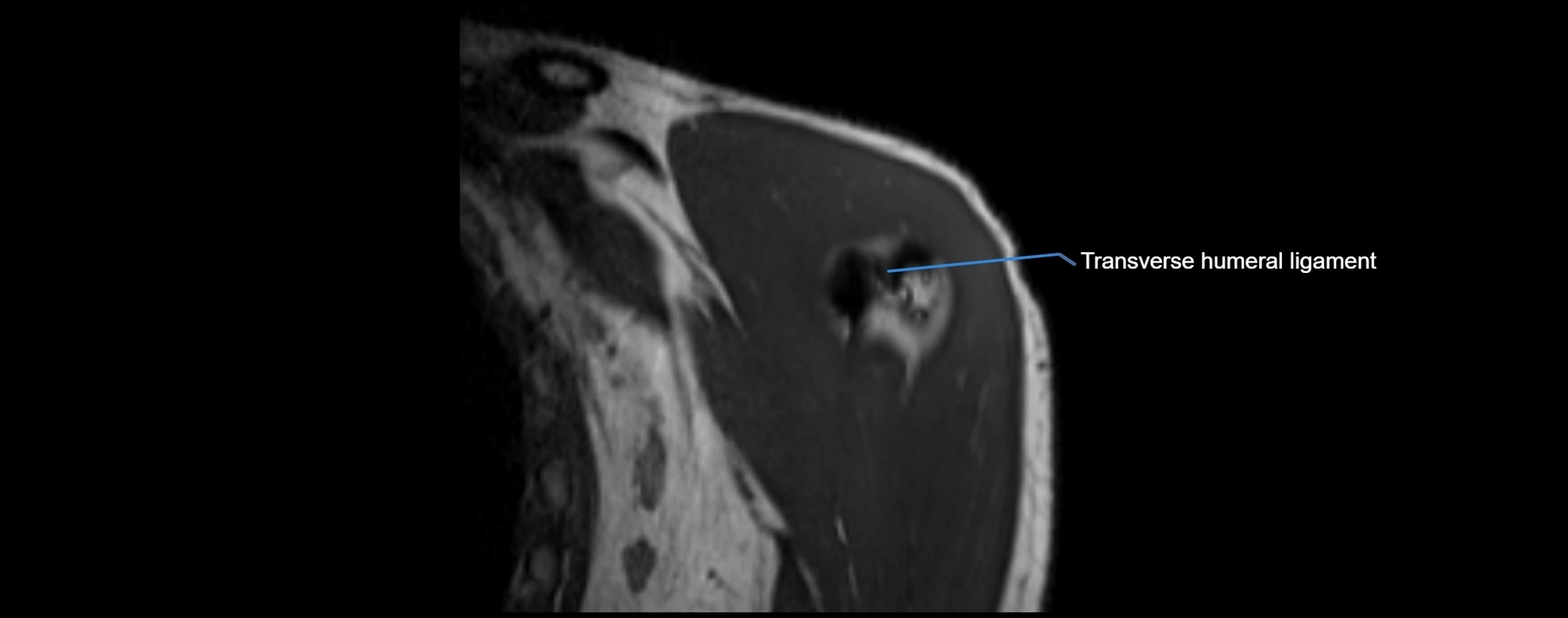 shoulder ligments coronal  cross sectional anatomy 3T MRI AI enhanced radiology image -img-00001-00003.webp